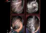 Hair Loss Treatment for Men Mens Hair Loss