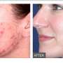 Reveal a Healthier and Younger Looking Skin with Microdermabrasion Sydney