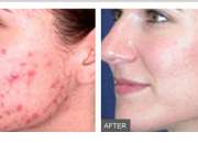 Reveal a Healthier and Younger Looking Skin with Microdermabrasion Sydney